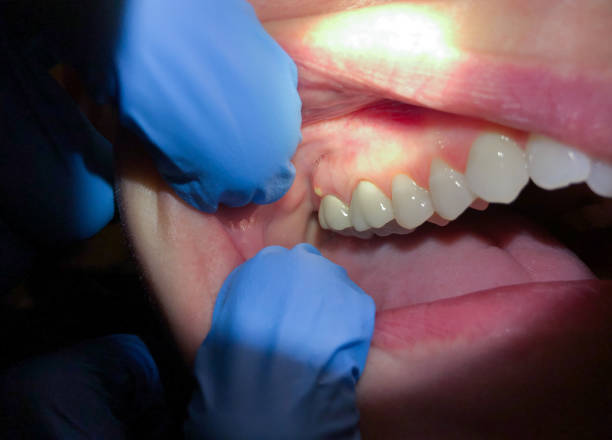 Best Emergency Denture Repair in Middle Valley, TN